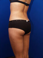 Liposuction