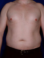 Male Liposuction