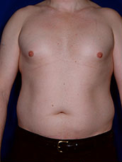 Male Liposuction