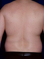 Male Liposuction