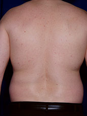 Male Liposuction