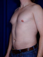 Male Liposuction