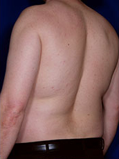 Male Liposuction