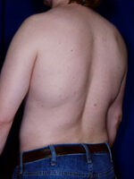Male Liposuction