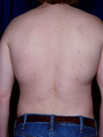 Male Liposuction