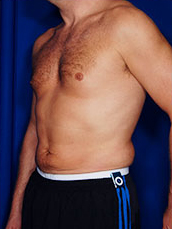Male Liposuction