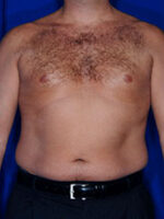 Male Liposuction