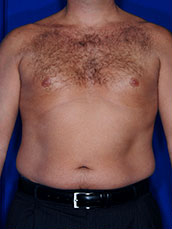 Male Liposuction