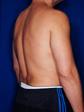Male Liposuction