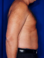 Male Liposuction