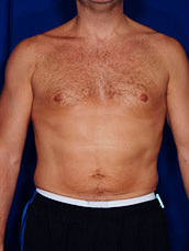 Male Liposuction