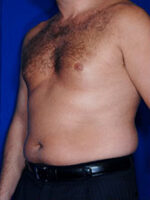 Male Liposuction
