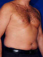 Male Liposuction