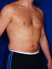 Male Liposuction