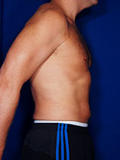 Male Liposuction