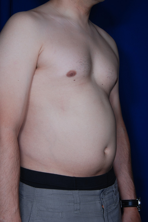 Male Liposuction