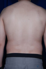 Male Liposuction