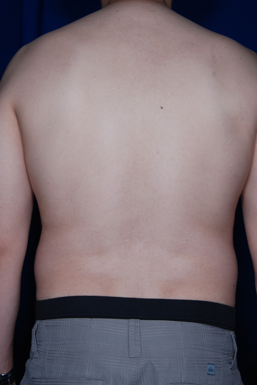 Male Liposuction