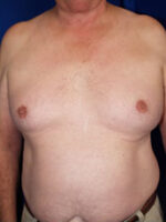 Male Liposuction