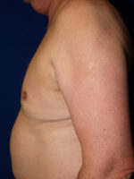 Male Liposuction