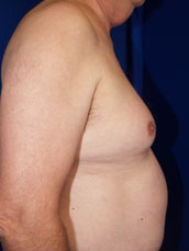 Male Liposuction