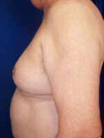 Male Liposuction
