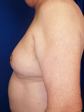 Male Liposuction