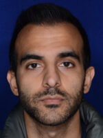 Hair Transplant