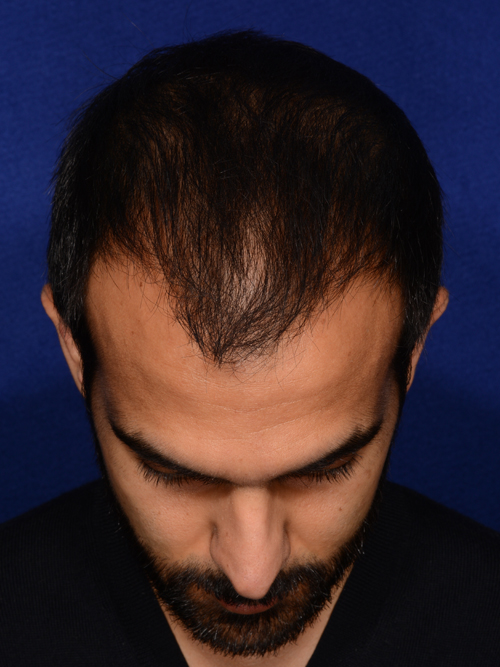 Hair Transplant