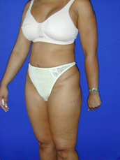 Liposuction