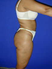 Liposuction