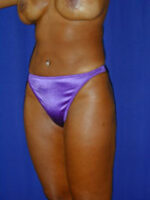Liposuction
