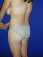 Liposuction