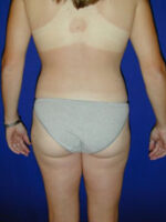 Liposuction