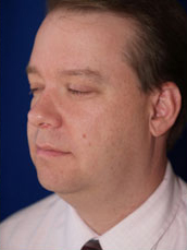Male Liposuction