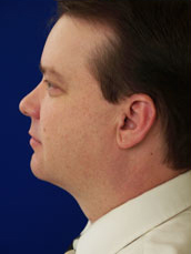 Male Liposuction