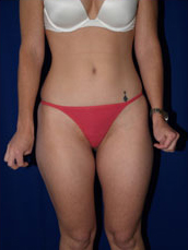 Liposuction