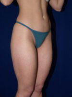 Liposuction