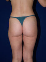 Liposuction