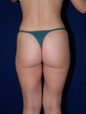Liposuction