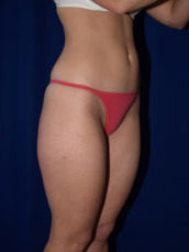 Liposuction