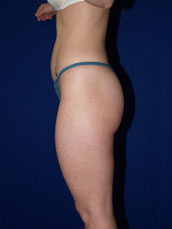 Liposuction