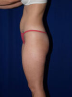 Liposuction