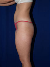 Liposuction