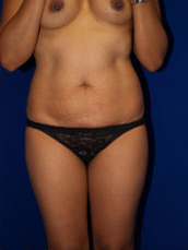 Liposuction