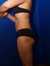 Liposuction