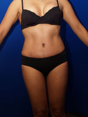 Liposuction