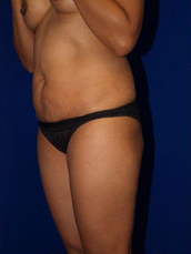 Liposuction