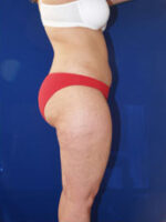 Liposuction