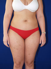 Liposuction